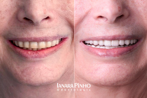 Antes e depois de implante dentário com resultado natural