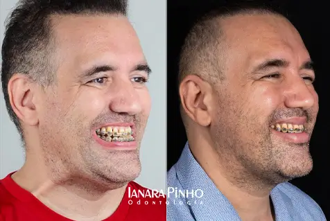 Imagem mostra antes e depois de realizar Cirurgia Ortognática na Ianara Pinho Odontologia