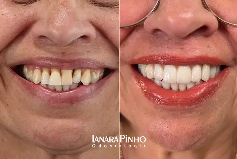 Imagem mostra antes e depois de realizar Lentes de contato em porcelana na Ianara Pinho Odontologia