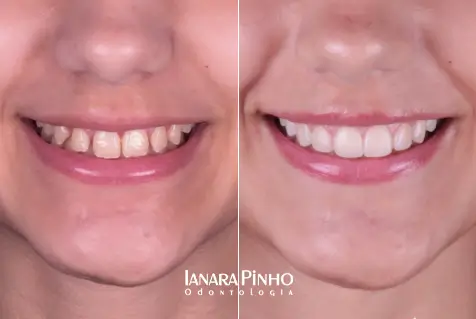 Imagem mostra antes e depois de realizar facetas dentárias na Ianara Pinho Odontologia