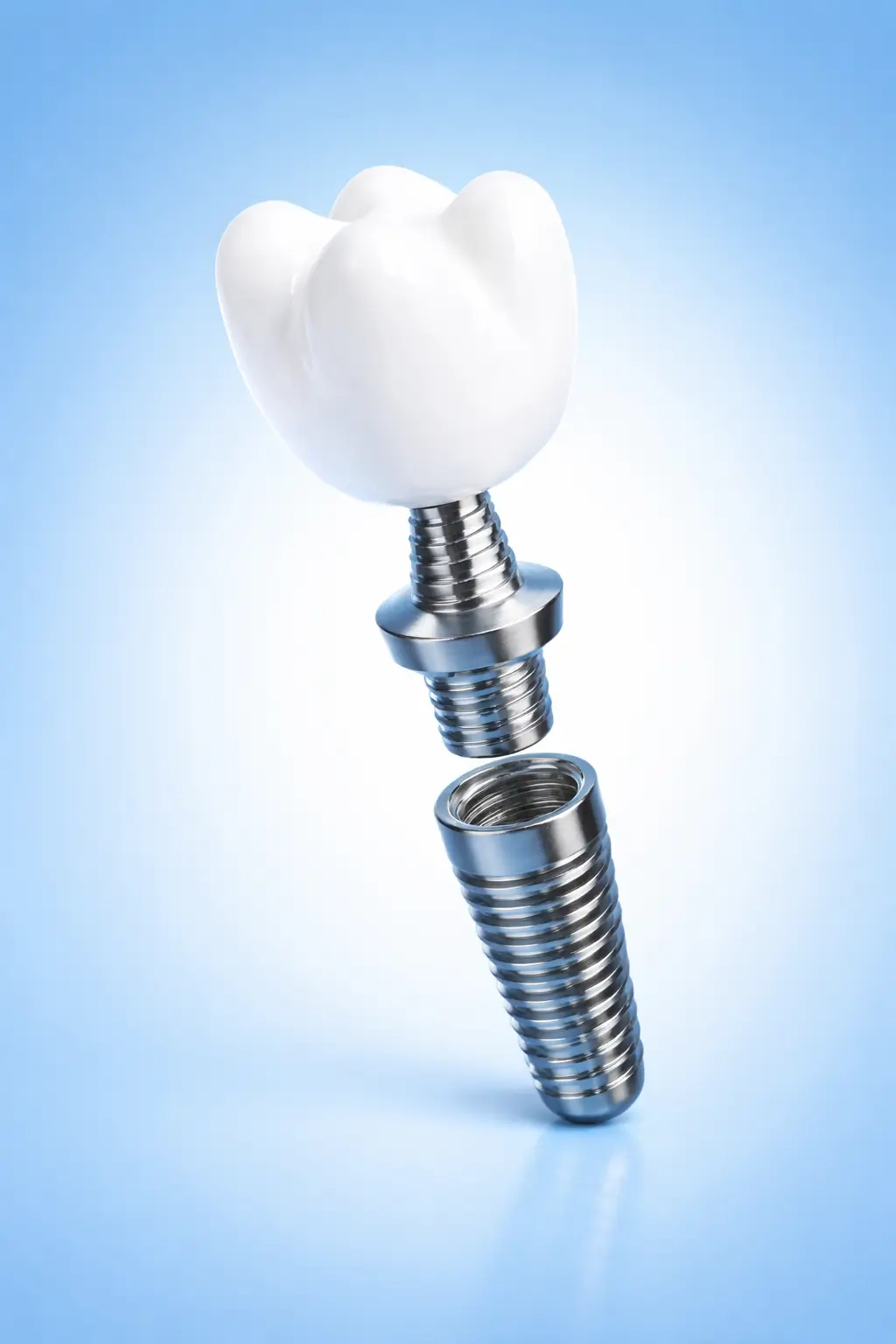 Imagem ilustrativa de implante dentário