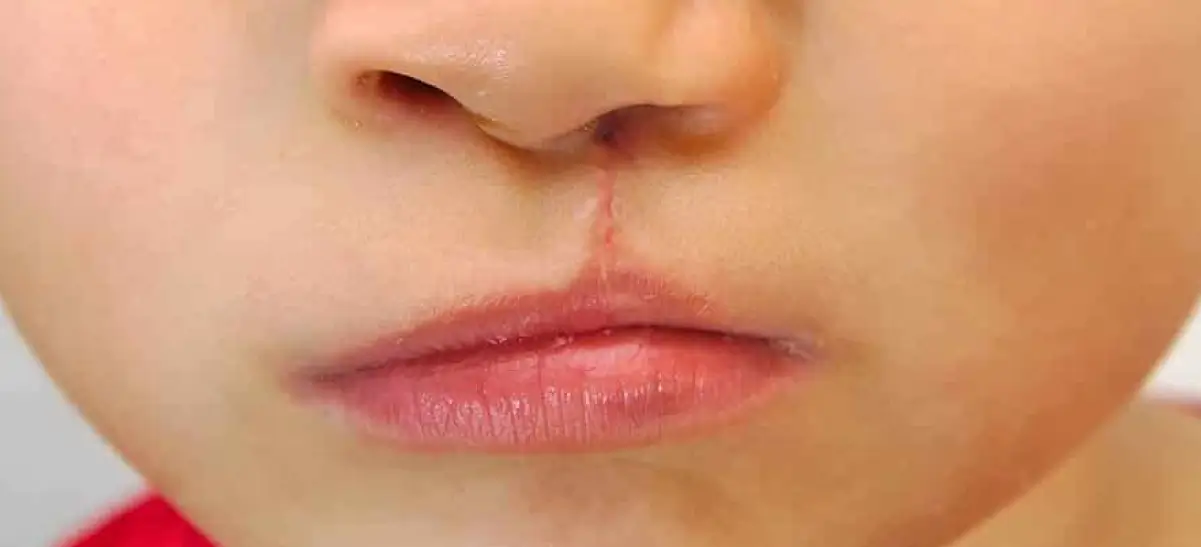 Criança com cicatriz de Labio Leporino