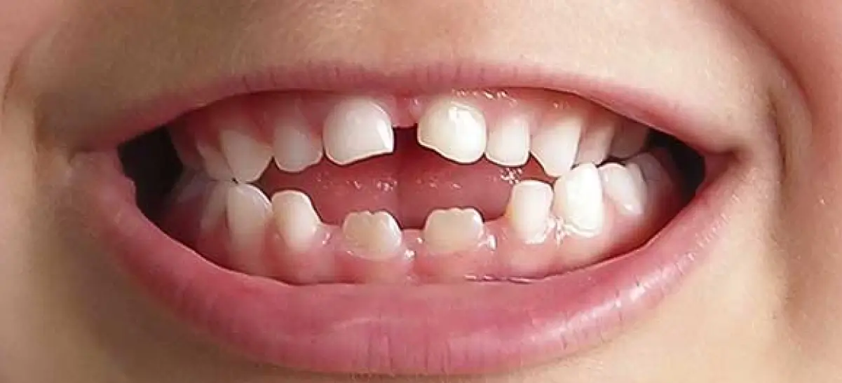 Close-up de sorriso infantil com mordida aberta e dentes anteriores desalinhados