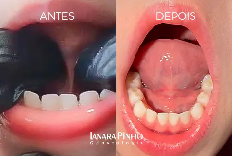 Antes e Depois da Frenectomia