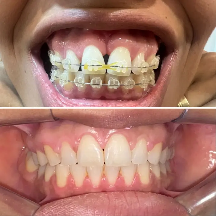 Antes e depois do tratamento com aparelho ortodôntico realizado na Clínica Ianara Pinho