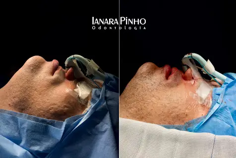 Comparação do perfil facial antes e depois da cirurgia ortognática